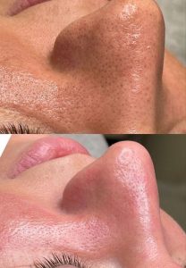 فواید فیشیال برای پوست