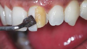 کامپوزیت دندان چیست؟